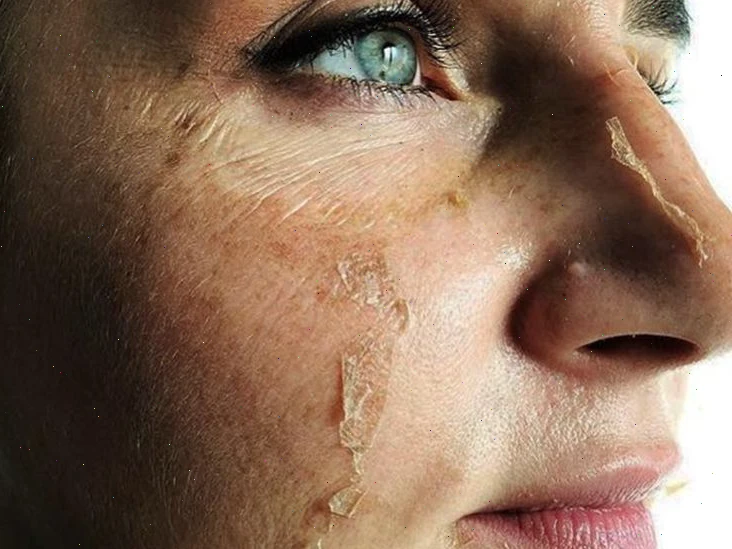 Как готовиться к пилингу?